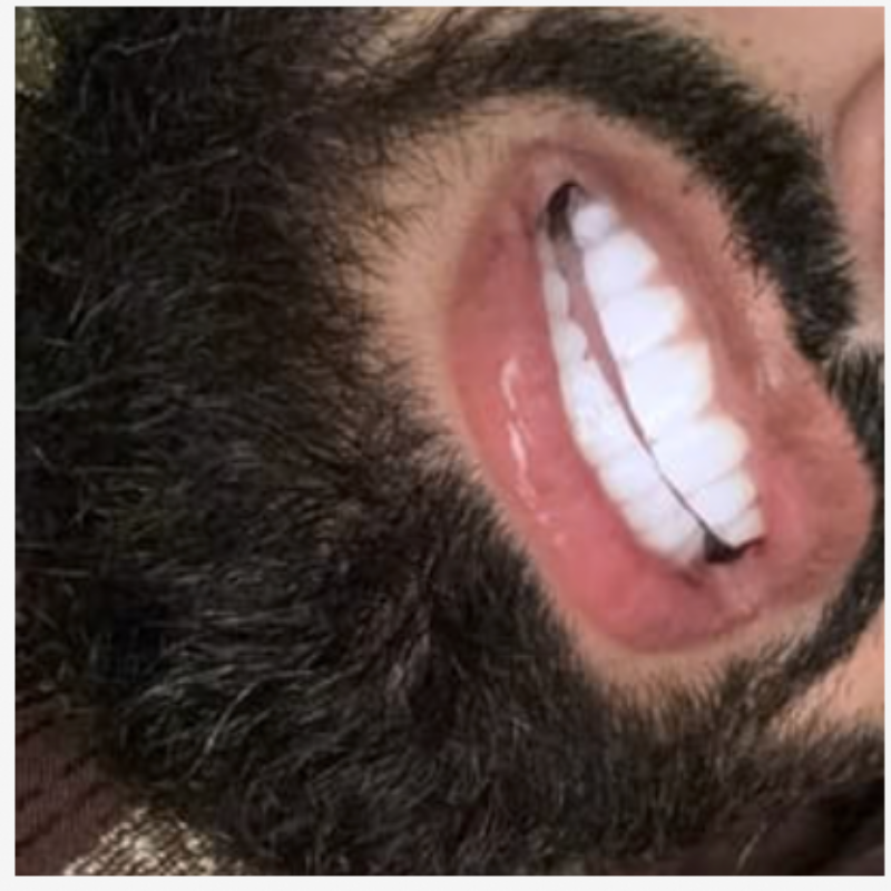 Noovea LuxeSmile Set | Brighten Your Smile with Ease