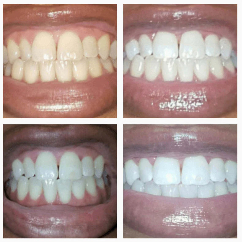 Noovea LuxeSmile Set | Brighten Your Smile with Ease