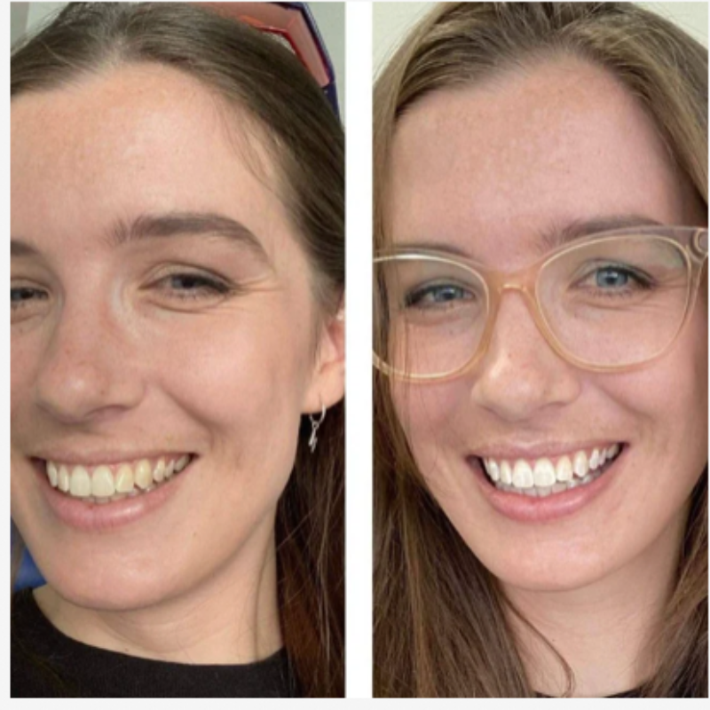 Noovea LuxeSmile Set | Brighten Your Smile with Ease
