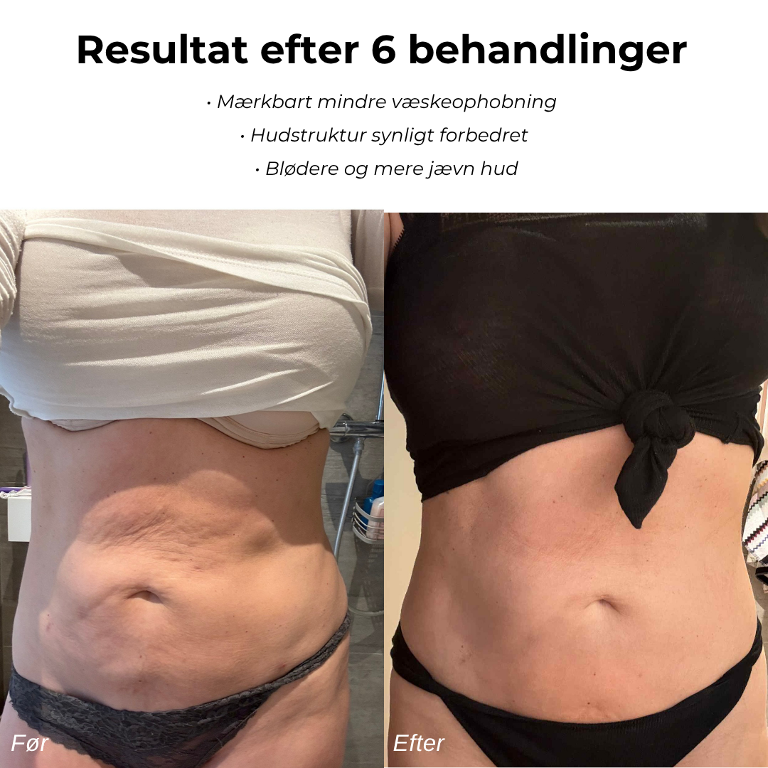 CelluSmooth™ - Anti cellulite massageapparat
