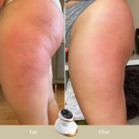 CelluSmooth™ - Anti cellulite massageapparat